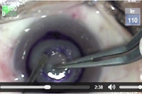 ESCRS 2013 Video