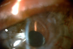 cornea3