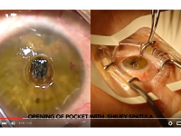 KeraKlear Artificial Cornea Implantation by Kashif Baig, MD