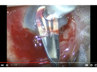 KeraKlear Implantation Technique by Dr. Kanellopoulos