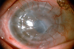 cornea1