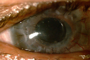 cornea2